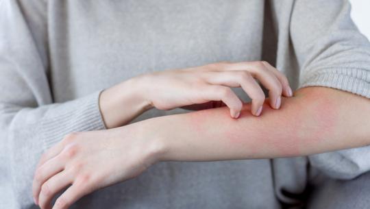 arm with rash