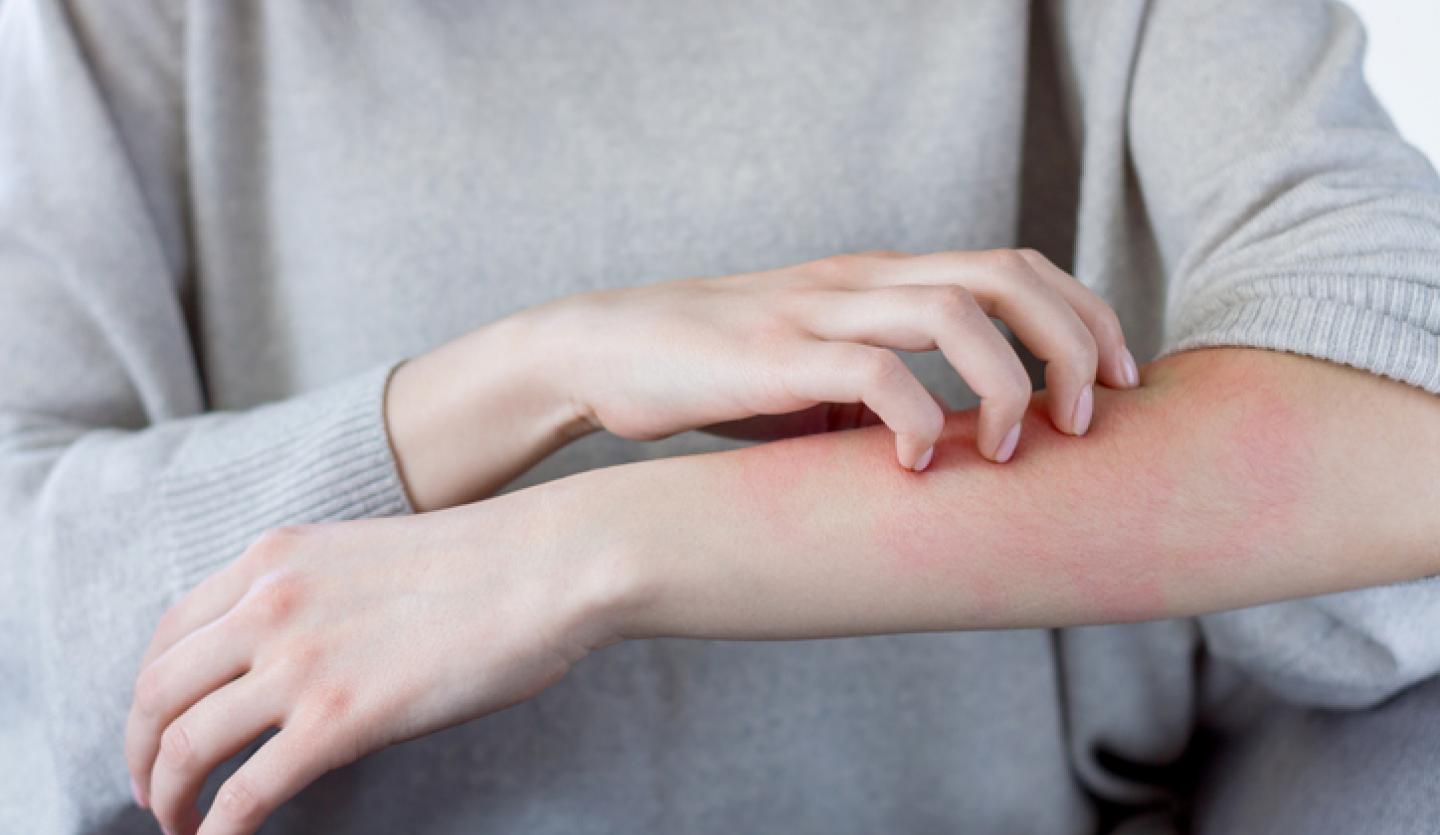 arm with rash